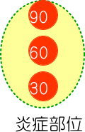 炎症の部位